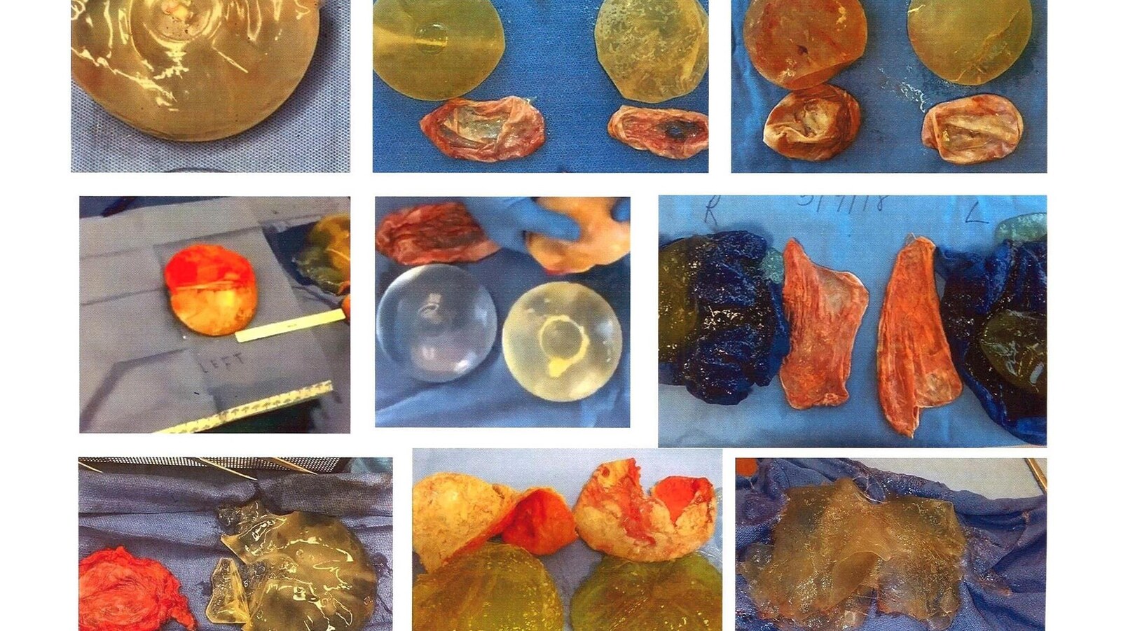Photo d’implants mammaires