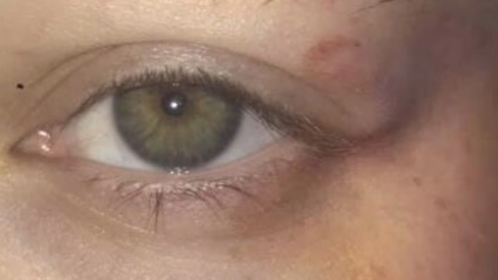 Une ecchymose se trouve à côté d'un oeil.