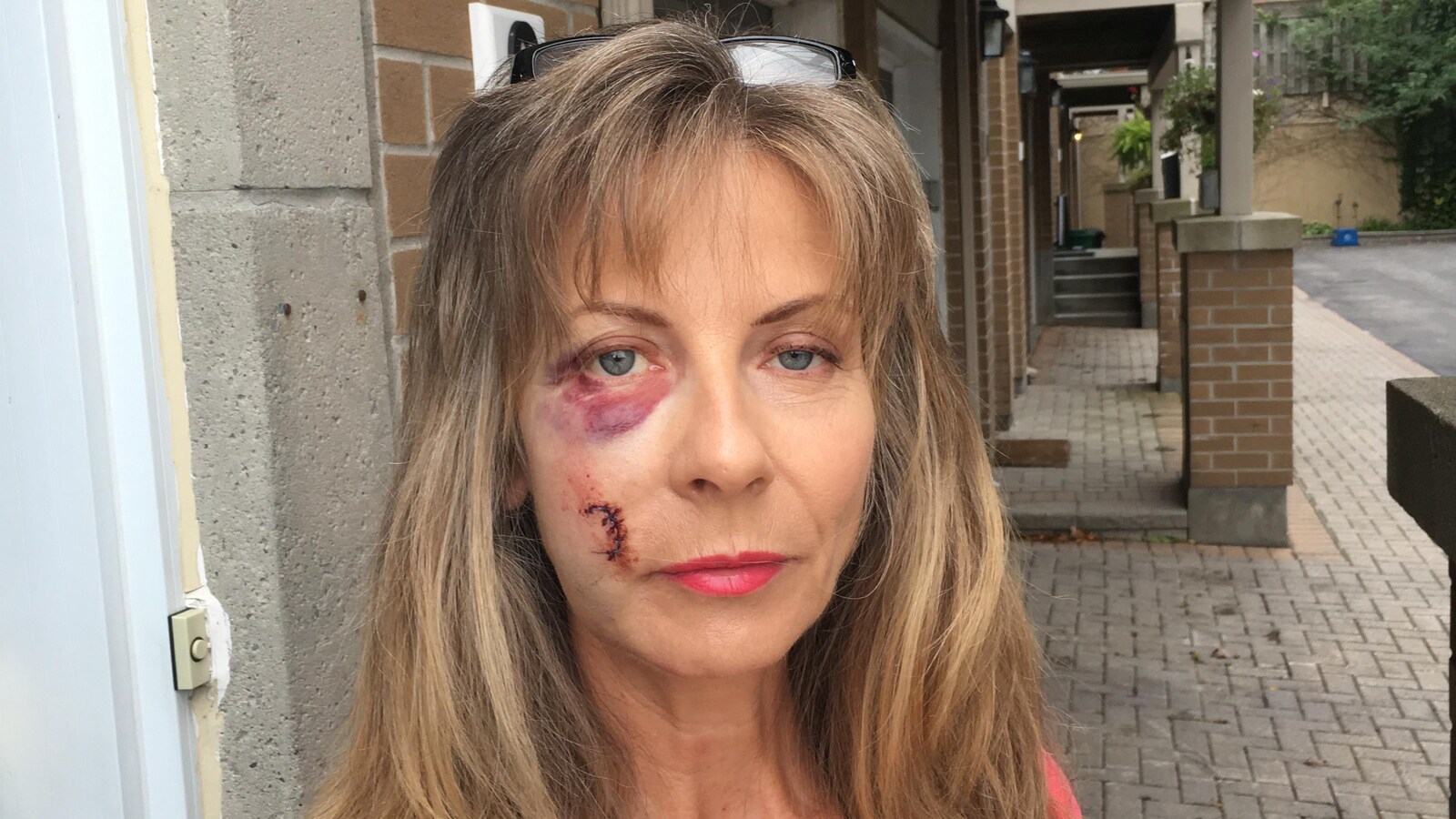 Une femme avec le visages couvert de cicatrices et d'ecchymoses.