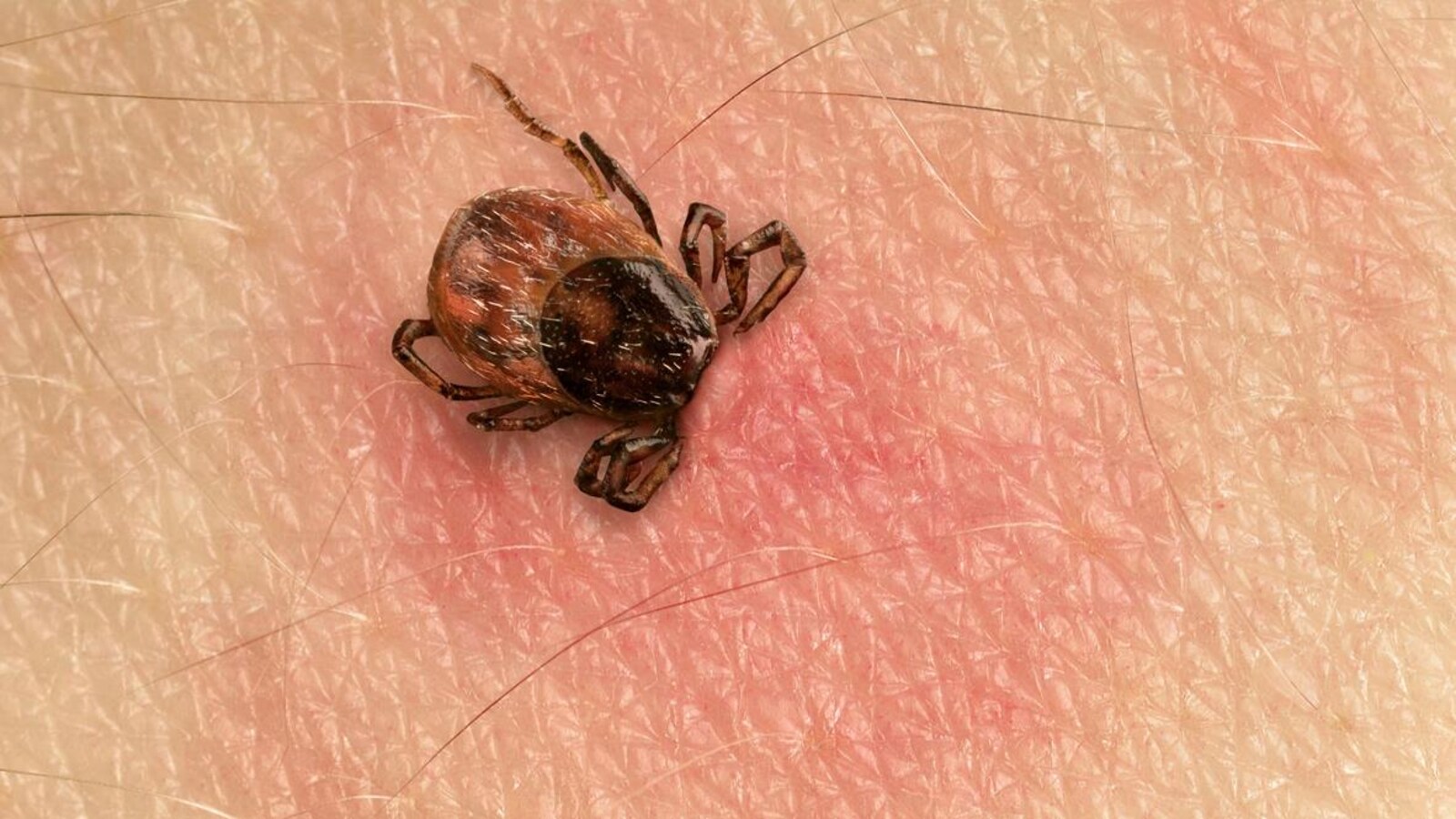 Une tique mord la peau d'une personne