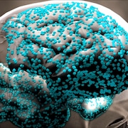 Représentation du cerveau montant la progression de la maladie d'Alzheimer dans le devant du cerveau.