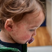 Un enfant atteint de la rougeole.