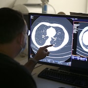 Un radiologiste analyse l'image d'un nodule sur l'image du poumon d'un fumeur.