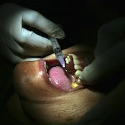 La bouche ouverte d'une femme âgée pendant que le dentiste lui fait une piqûre.