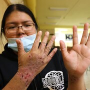 Une femme montre ses mains avec des plaies dessus dues à l'eczema.