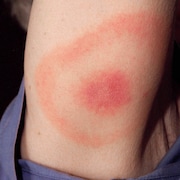 Rougeur causée par une morsure de tique infectée par une bactérie, sur l’avant-bras d’une femme du Maryland qui a par la suite développé la maladie de Lyme.