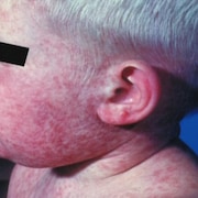 Un jeune enfant atteint de la rougeole est couvert de plaques rouges. 