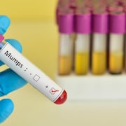 Une main enveloppée d'un gant de latex bleu tient un vaccin contre les oreillons. 