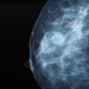 La mammographie d'une femme.