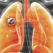 Modélisation par ordinateur de poumons atteints d'un cancer.