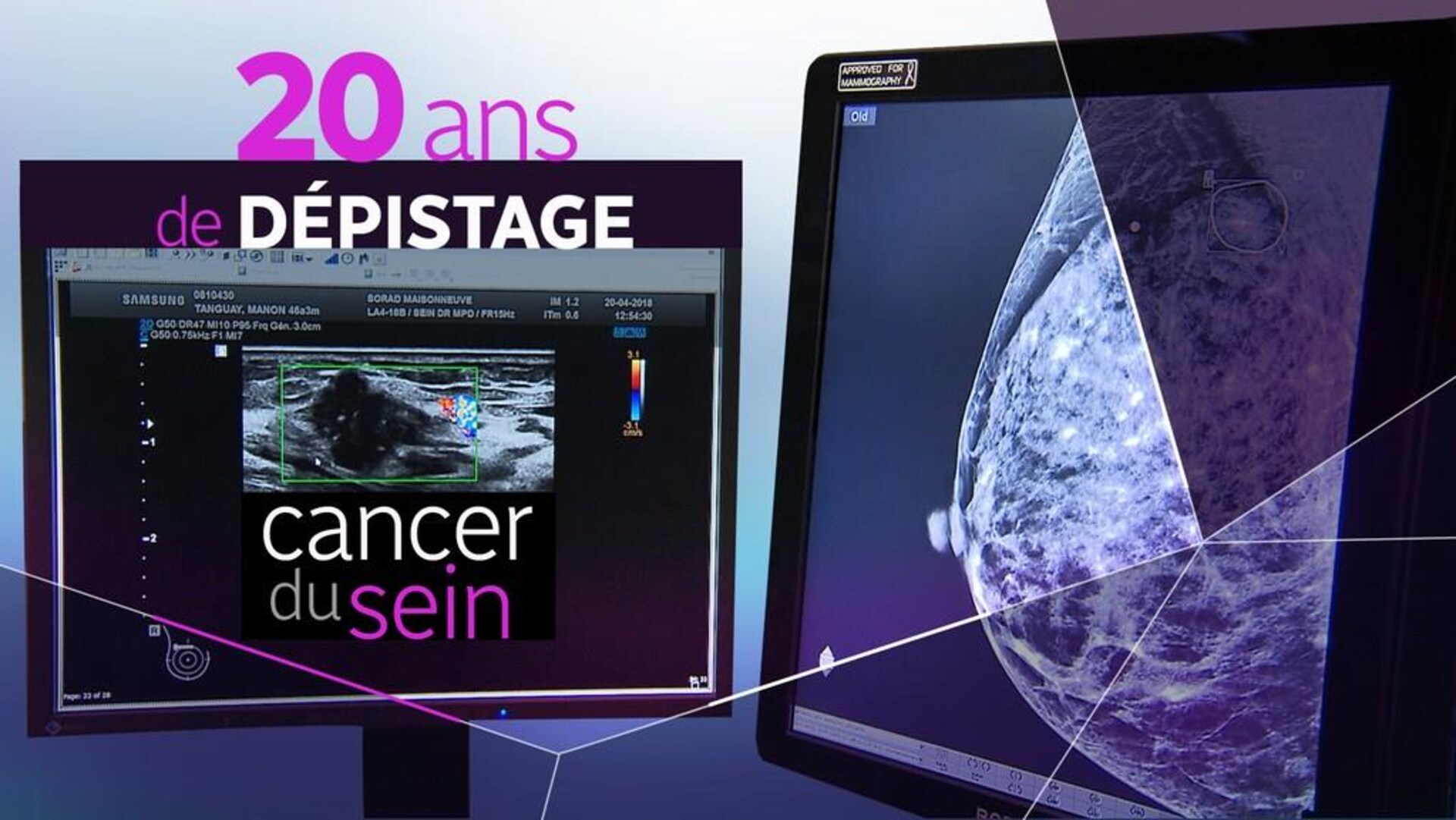 Le Programme Québécois De Dépistage Du Cancer Du Sein A 20 Ans Info