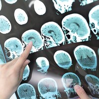 Images du cerveau d'un patient atteint de sclérose en plaques.