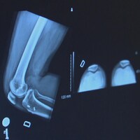 Gros plan d'une radiographie du genou.