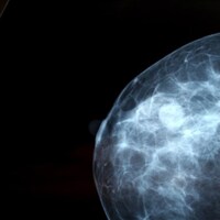 une mammographie. 