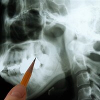 Radiographie d'une mâchoire humaine