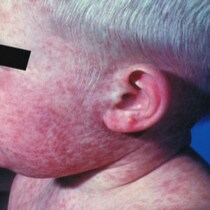 Un jeune enfant atteint de la rougeole est couvert de plaques rouges. 