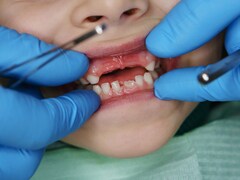 La bouche ouverte d'un enfant dont des dents manquent.