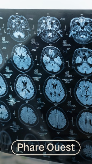 Le Dr Thomas Tannou, chercheur en émergence au Centre de recherche de l’Institut universitaire de gériatrie de Montréal, discute du nouveau traitement pour les troubles cognitifs légers et la maladie d'Alzheimer au stade léger homologué par Santé Canada.