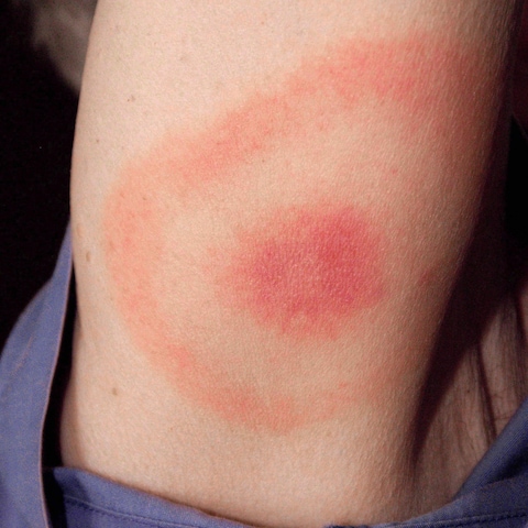 Rougeur typique d'une morsure de tique infectée par une bactérie, sur l’avant-bras d’une femme du Maryland qui a par la suite eu la maladie de Lyme. Rougeur typique d'une morsure de tique infectée par une bactérie, sur l’avant-bras d’une femme du Maryland qui a par la suite eu la maladie de Lyme.