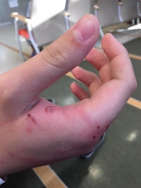 Une main avec des blessures. Une main avec des blessures.