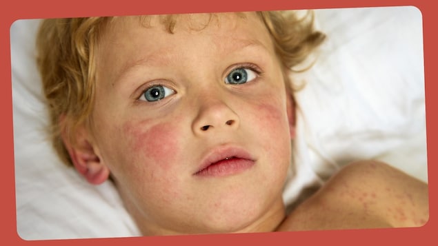 Il a des points rouges sur le visage et le corps. 