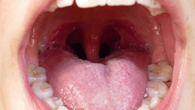 children with oral health and tonsillitis,
