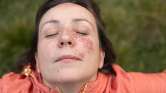 Une femme avec une tache de naissance sur le visage