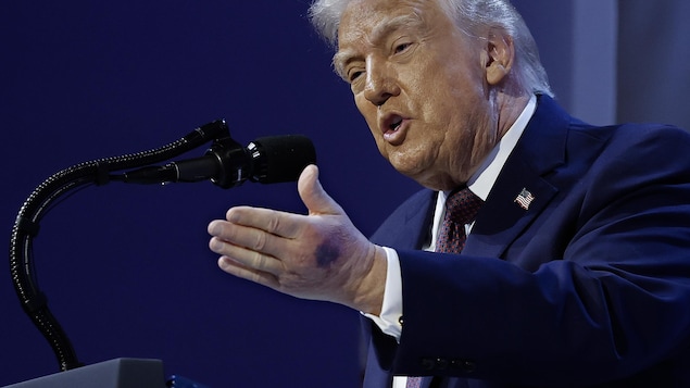 Une ecchymose est visible sur la main gauche de Donald Trump, alors qu'il s'adresse à un public derrière un micro.