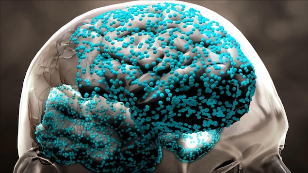 Représentation du cerveau montant la progression de la maladie d'Alzheimer.