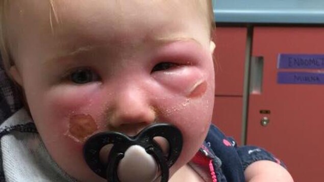 Enfant présentant des cloques au visage Enfant présentant des cloques au visage