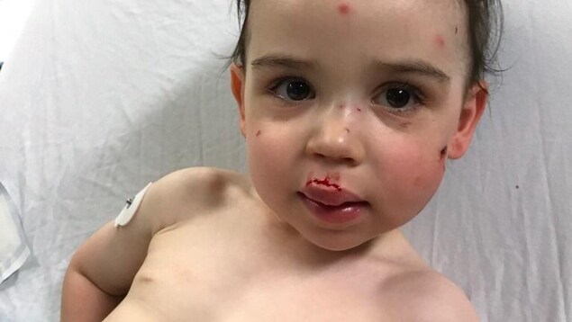 Un jeune enfant avec des blessures au visage dans un lit d'hôpital. Un jeune enfant avec des blessures au visage dans un lit d'hôpital.