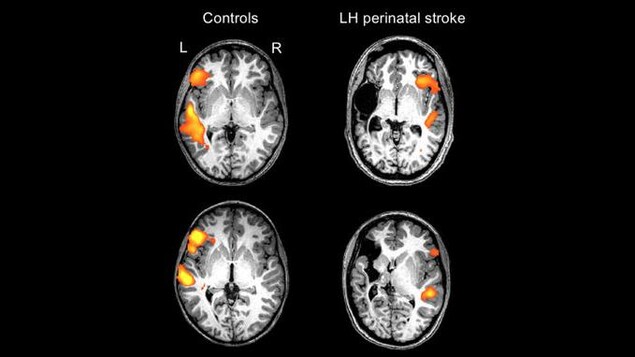 Imagerie du cerveau d'adolescents ayant subi un AVC lorsqu'ils étaient bébés. Imagerie du cerveau d'adolescents ayant subi un AVC lorsqu'ils étaient bébés.
