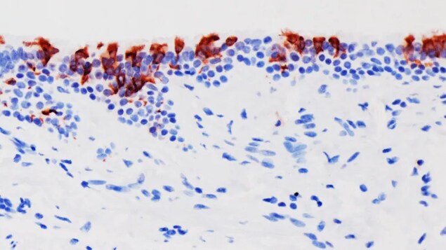 An enlarged view of human bronchus tissue infected with the Omicron variant of the SARS-CoV-2 coronavirus (in red) in laboratory research from a team in Hong Kong. 