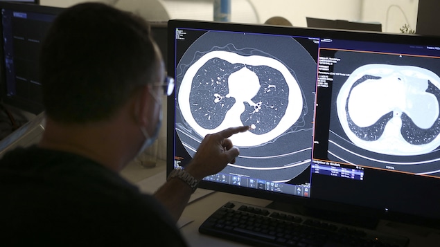 Un radiologiste analyse l'image d'un nodule sur un scan du poumon d'un fumeur.