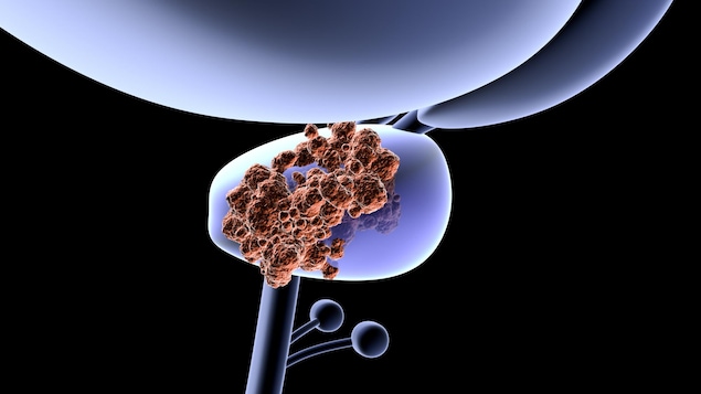 Illustration montrant une prostate recouverte de tumeurs cancéreuses.