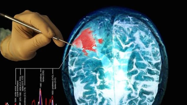 Cellules cancéreuses au cerveau Cellules cancéreuses au cerveau