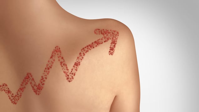 Les cas de rougeole sont en augmentation dans plusieurs provinces canadiennes.