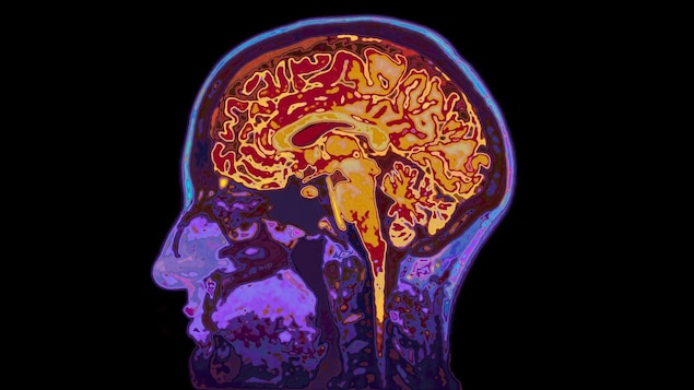 Le glucose à nouveau associé à un vieillissement prématuré du cerveau