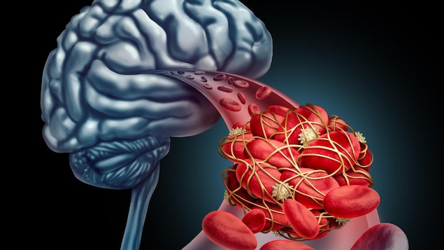 Illustration d'un caillot dans un vaisseau sanguin du cerveau.