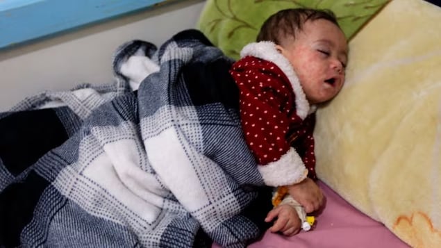 A Yemeni child receiving treatment for measles rests at al-Sabeen Maternity and Child Hospital in Sanaa on March 21, 2021. 