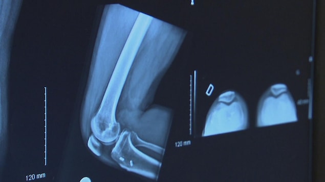 Voici comment des physiothérapeutes peuvent aider à réduire l’attente en orthopédie