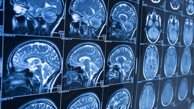 A group of CAT scans show the human brain. A leading Canadian microbiologist says he was effectively 'cut off' from further work investigating a string of brain illnesses in New Brunswick, according to an email he wrote last fall.
