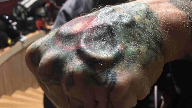 On voit son implant en gros plan couvert par un tatouage. On voit son implant en gros plan couvert par un tatouage.