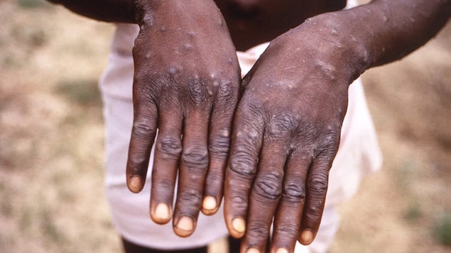 Durante un brote de viruela del mono en la República Democrática del Congo, un joven muestra sus manos, que presentan la erupción característica de la viruela del mono durante la fase de recuperación. 