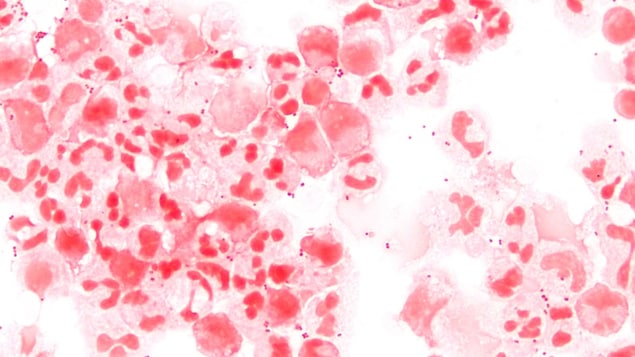 Dangerous bacterial infection hits highest level seen in Canada in more than a decade