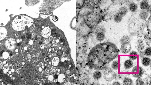 A close-up look at the Omicron variant of SARS-CoV-2. At left, low magnification electron micrograph imaging shows a cell after infection. At right, high magnification electron micrograph imaging shows that infected cell and viral particles with corona-shaped spikes on their surface. (HKUMed and Electron Microscope Unit/HKU)