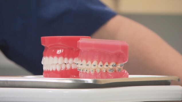 Deux dentiers, un avec des broches et un avec un aligneur.