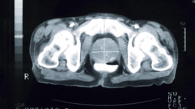 Prostate