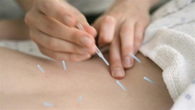 Un traitement d'acupuncture.