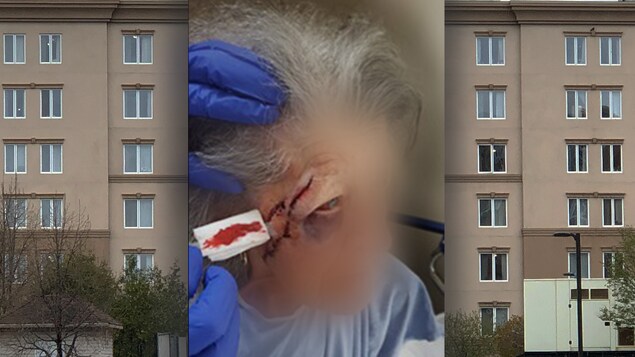 Photo de blessures d'une dame âgée.